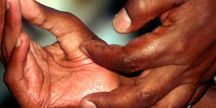 नेपालमा कुष्ठरोग निवारण घोषणा गरे पनि बाँके कुष्ठरोगीको उच्च जोखिम