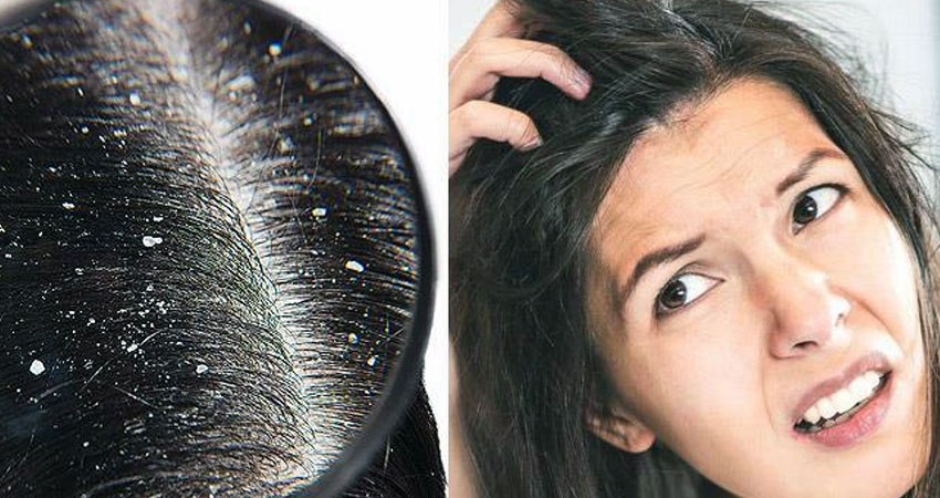 कपालमा चाया परेर हैरानीमा हुनुहुन्छ ? यसरी गर्नुहाेस् उपचार