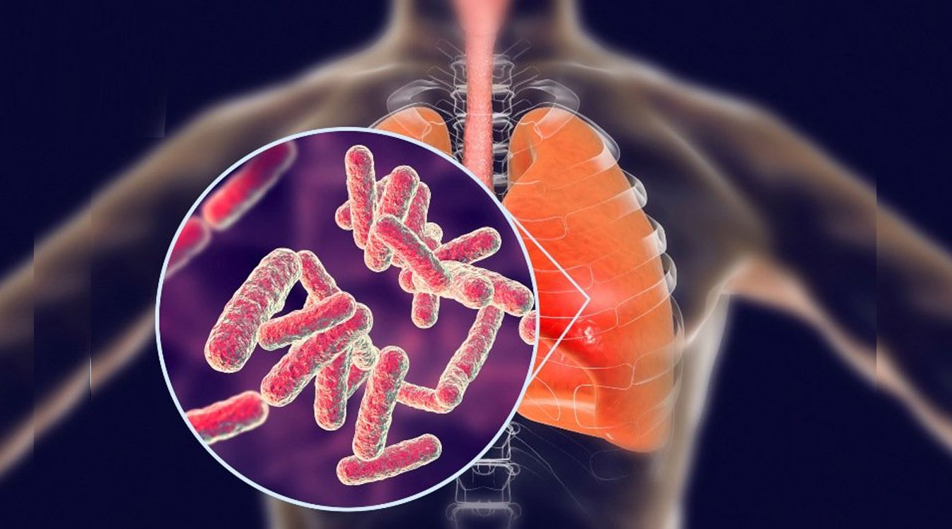 विश्वमा एक करोड सात लाखमा सक्रिय क्षयरोगी, नेपालका ४२ प्रतिशत उपचार बाहिर