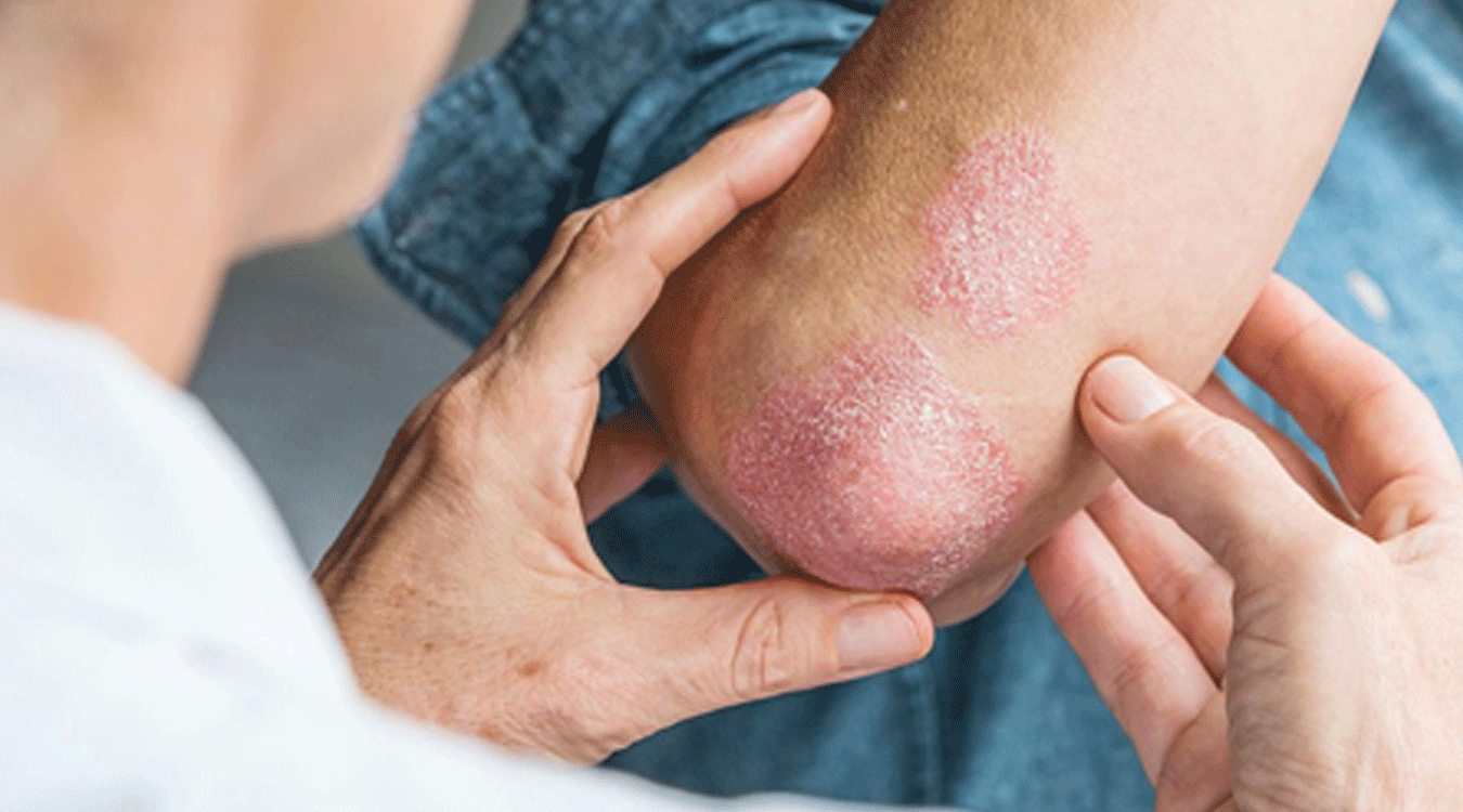 सुदूरपश्चिममा कुष्ठरोगको समस्या यथावत